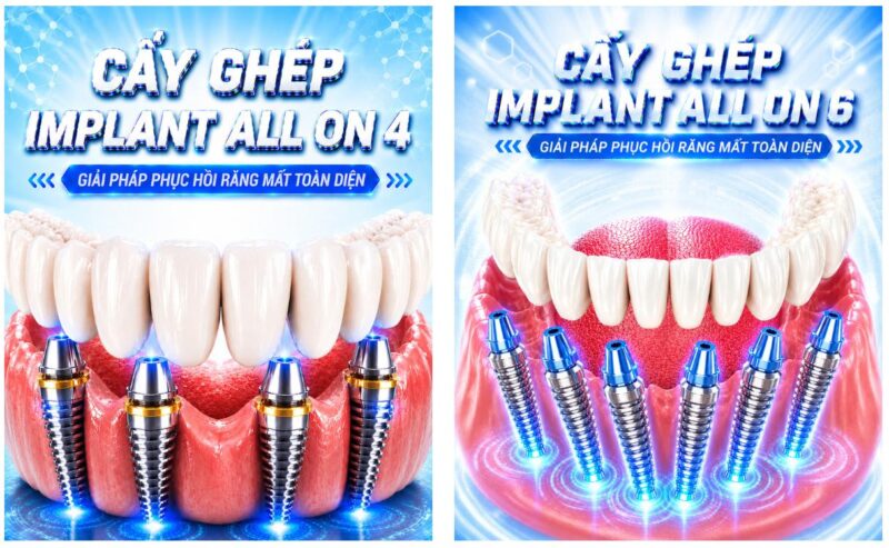 Phương pháp trồng răng implant toàn hàm tại Nha Khoa Trồng Răng Sài Gòn